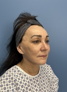 Brow Lift Before Photo by Lisa Brostrom, MD; San Antonio, TX - Case 49915