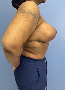 Breast Implant Revision After Photo by Lisa Brostrom, MD; San Antonio, TX - Case 49918