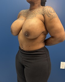 Breast Implant Revision Before Photo by Lisa Brostrom, MD; San Antonio, TX - Case 49918