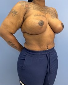 Breast Implant Revision After Photo by Lisa Brostrom, MD; San Antonio, TX - Case 49918