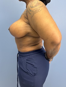 Breast Implant Revision After Photo by Lisa Brostrom, MD; San Antonio, TX - Case 49918