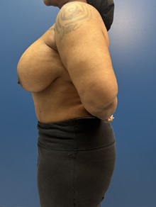 Breast Implant Revision Before Photo by Lisa Brostrom, MD; San Antonio, TX - Case 49918