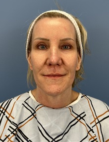 Facelift Before Photo by Lisa Brostrom, MD; San Antonio, TX - Case 49921 Facelift Before Photo by Lisa Brostrom, MD; San Antonio, TX - Case 49921