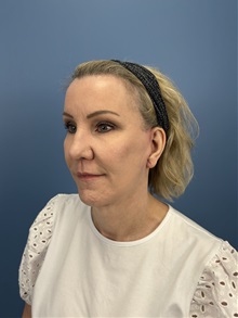 Facelift After Photo by Lisa Brostrom, MD; San Antonio, TX - Case 49921