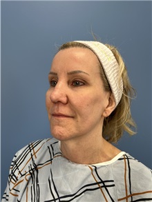 Facelift Before Photo by Lisa Brostrom, MD; San Antonio, TX - Case 49921