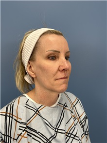 Facelift Before Photo by Lisa Brostrom, MD; San Antonio, TX - Case 49921