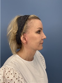 Facelift After Photo by Lisa Brostrom, MD; San Antonio, TX - Case 49921
