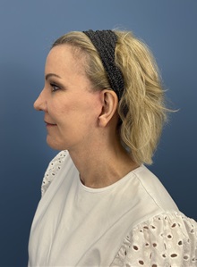Facelift After Photo by Lisa Brostrom, MD; San Antonio, TX - Case 49921