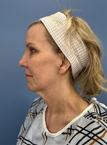 Facelift Before Photo by Lisa Brostrom, MD; San Antonio, TX - Case 49921