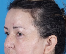Brow Lift After Photo by Lisa Brostrom, MD; San Antonio, TX - Case 49922