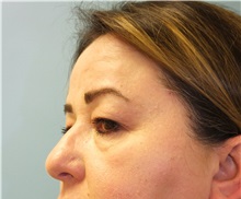 Brow Lift Before Photo by Lisa Brostrom, MD; San Antonio, TX - Case 49922
