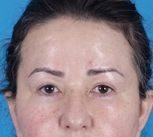 Brow Lift After Photo by Lisa Brostrom, MD; San Antonio, TX - Case 49922 Brow Lift After Photo by Lisa Brostrom, MD; San Antonio, TX - Case 49922