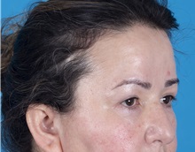 Brow Lift After Photo by Lisa Brostrom, MD; San Antonio, TX - Case 49922
