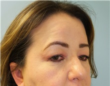 Brow Lift Before Photo by Lisa Brostrom, MD; San Antonio, TX - Case 49922