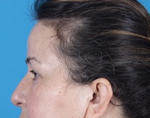 Brow Lift After Photo by Lisa Brostrom, MD; San Antonio, TX - Case 49922