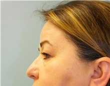 Brow Lift Before Photo by Lisa Brostrom, MD; San Antonio, TX - Case 49922