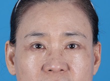 Eyelid Surgery After Photo by Lisa Brostrom, MD; San Antonio, TX - Case 49925 Eyelid Surgery After Photo by Lisa Brostrom, MD; San Antonio, TX - Case 49925