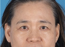 Eyelid Surgery Before Photo by Lisa Brostrom, MD; San Antonio, TX - Case 49925 Eyelid Surgery Before Photo by Lisa Brostrom, MD; San Antonio, TX - Case 49925
