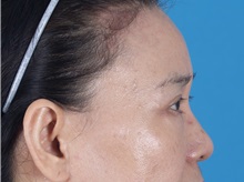 Eyelid Surgery After Photo by Lisa Brostrom, MD; San Antonio, TX - Case 49925