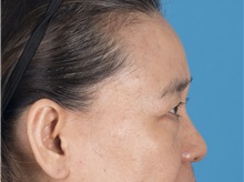 Eyelid Surgery Before Photo by Lisa Brostrom, MD; San Antonio, TX - Case 49925