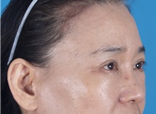 Eyelid Surgery After Photo by Lisa Brostrom, MD; San Antonio, TX - Case 49925