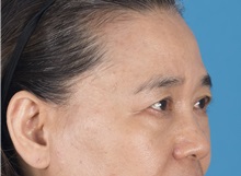 Eyelid Surgery Before Photo by Lisa Brostrom, MD; San Antonio, TX - Case 49925