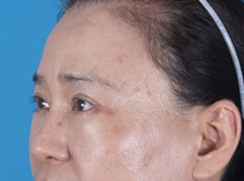 Eyelid Surgery After Photo by Lisa Brostrom, MD; San Antonio, TX - Case 49925