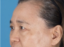 Eyelid Surgery Before Photo by Lisa Brostrom, MD; San Antonio, TX - Case 49925