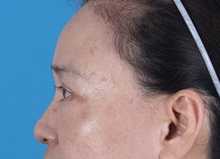 Eyelid Surgery After Photo by Lisa Brostrom, MD; San Antonio, TX - Case 49925