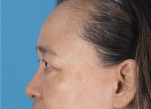 Eyelid Surgery Before Photo by Lisa Brostrom, MD; San Antonio, TX - Case 49925