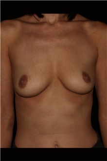 Breast Augmentation Before Photo by Carlos Mata, MD, MBA, FACS; Scottsdale, AZ - Case 44663