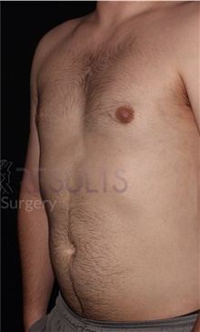 Male Breast Reduction After Photo by Carlos Mata, MD, MBA, FACS; Scottsdale, AZ - Case 44667