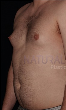 Male Breast Reduction Before Photo by Carlos Mata, MD, MBA, FACS; Scottsdale, AZ - Case 44667