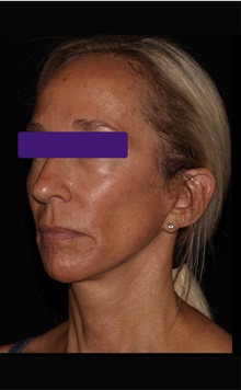 Facelift After Photo by Carlos Mata, MD, MBA, FACS; Scottsdale, AZ - Case 44674