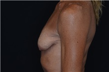 Breast Implant Removal After Photo by Landon Pryor, MD, FACS; Rockford, IL - Case 37682