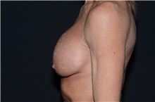 Breast Implant Removal Before Photo by Landon Pryor, MD, FACS; Rockford, IL - Case 37682