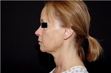 Facelift Before Photo by Landon Pryor, MD, FACS; Rockford, IL - Case 37695