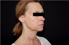 Facelift Before Photo by Landon Pryor, MD, FACS; Rockford, IL - Case 37695