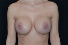 Breast Implant Revision After Photo by Landon Pryor, MD, FACS; Rockford, IL - Case 37696