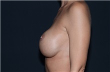 Breast Implant Revision Before Photo by Landon Pryor, MD, FACS; Rockford, IL - Case 37696