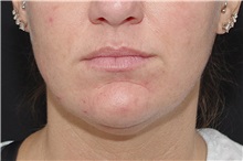 Dermal Fillers Before Photo by Landon Pryor, MD, FACS; Rockford, IL - Case 37698