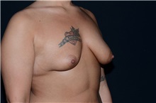 Breast Augmentation Before Photo by Landon Pryor, MD, FACS; Rockford, IL - Case 37699