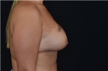 Breast Augmentation After Photo by Landon Pryor, MD, FACS; Rockford, IL - Case 37699