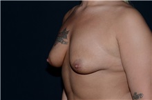 Breast Augmentation Before Photo by Landon Pryor, MD, FACS; Rockford, IL - Case 37699