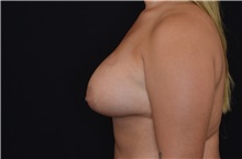 Breast Augmentation After Photo by Landon Pryor, MD, FACS; Rockford, IL - Case 37699