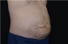 Body Contouring After Photo by Landon Pryor, MD, FACS; Rockford, IL - Case 37700