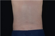 Body Contouring After Photo by Landon Pryor, MD, FACS; Rockford, IL - Case 37700