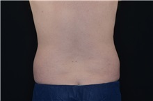 Body Contouring Before Photo by Landon Pryor, MD, FACS; Rockford, IL - Case 37700