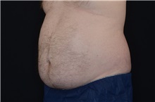 Body Contouring Before Photo by Landon Pryor, MD, FACS; Rockford, IL - Case 37700