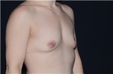 Breast Augmentation Before Photo by Landon Pryor, MD, FACS; Rockford, IL - Case 37701